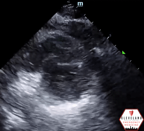 Intern Ultrasound of the Month: POCUS & Regional Wall Motion Abnormalities  — University Hospitals Emergency Medicine Residency