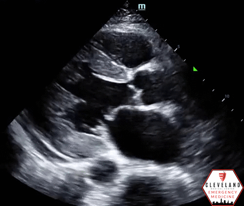 2-D echocardiography showing severe global hypokinesia and left