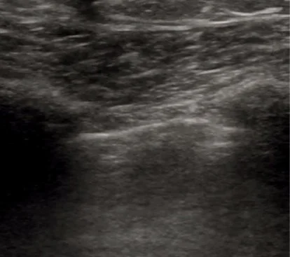 Intern Ultrasound of the Month: Pneumothorax