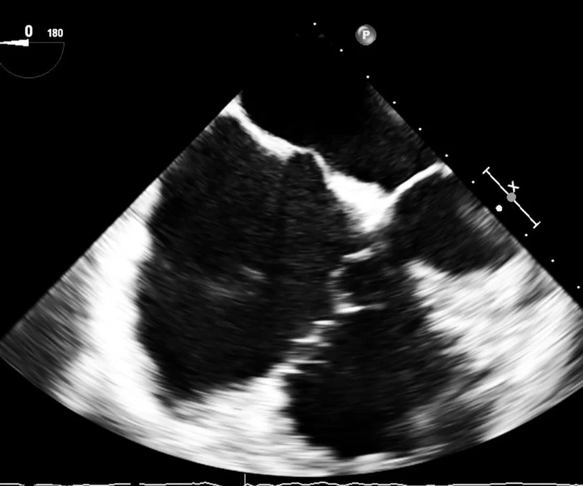 Resus: Resuscitative TEE: Background and Evidence