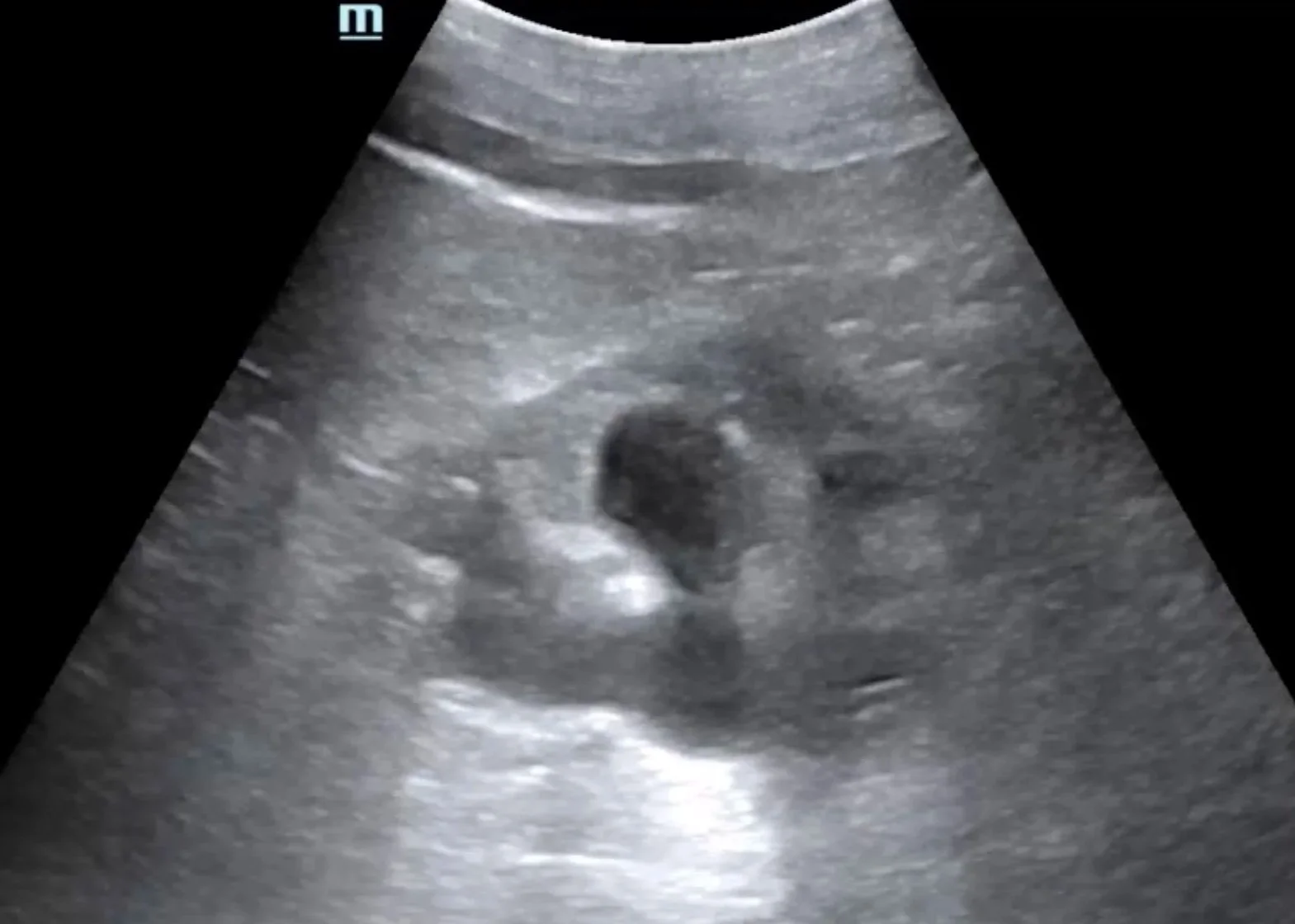 Intern Ultrasound of the Month: Hydronephrosis