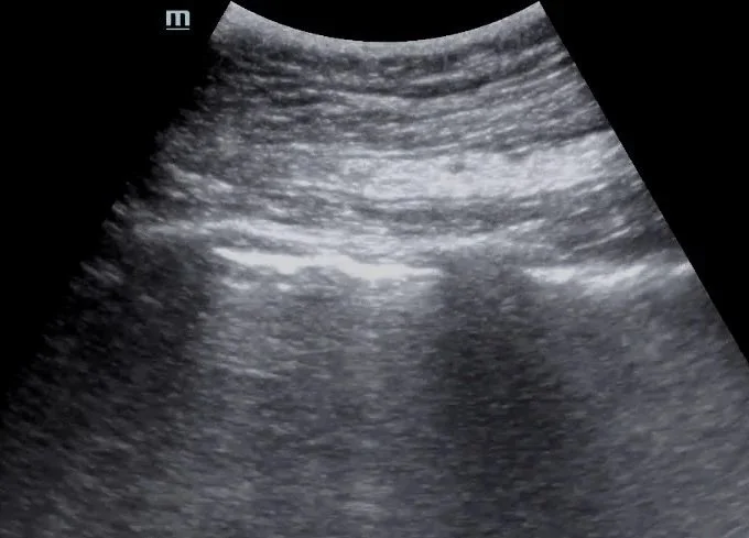 Intern Ultrasound of the Month: Pneumothorax 