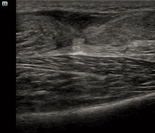 Intern Ultrasound of the Month: Achilles Tendon Rupture