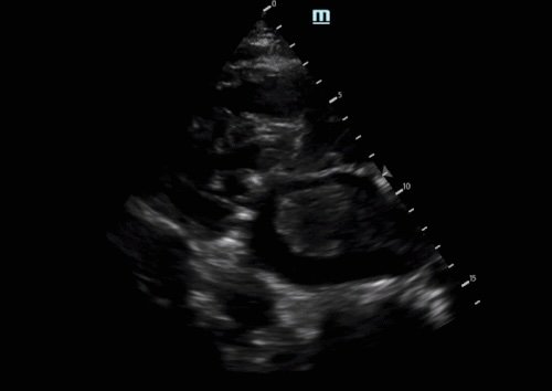 Intern Ultrasound of the Month: Left Atrial Mass vs Thrombus