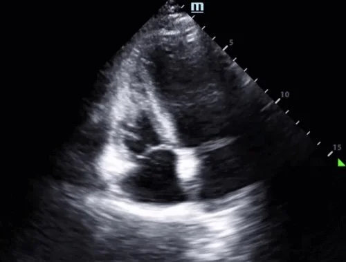 Intern Ultrasound of the Month: Lipomatous Atrial Septal Hypertrophy (LASH) &amp; Other Cardiac Masses 