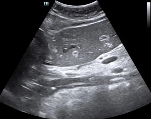 Intern Ultrasound of the Month: Detection of Aortic Dissection During Cardiac Arrest