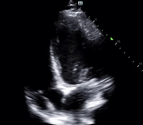 Intern Ultrasound of the Month: ICD Lead Dislodgment