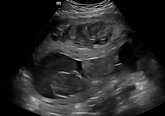 Intern Ultrasound of the Month: Placental Abruption
