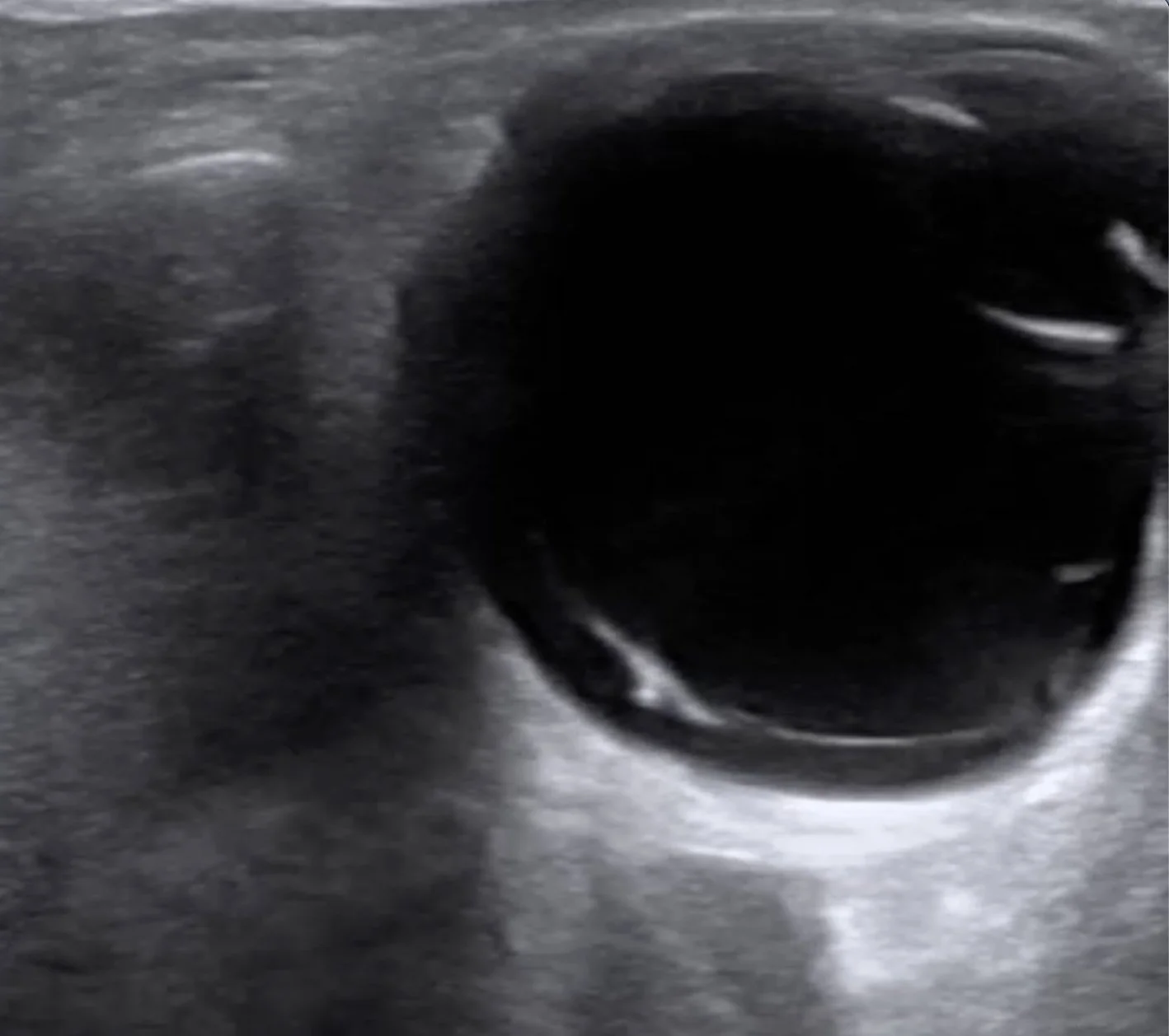 Intern Ultrasound of the Month: Posterior Vitreous Detachment