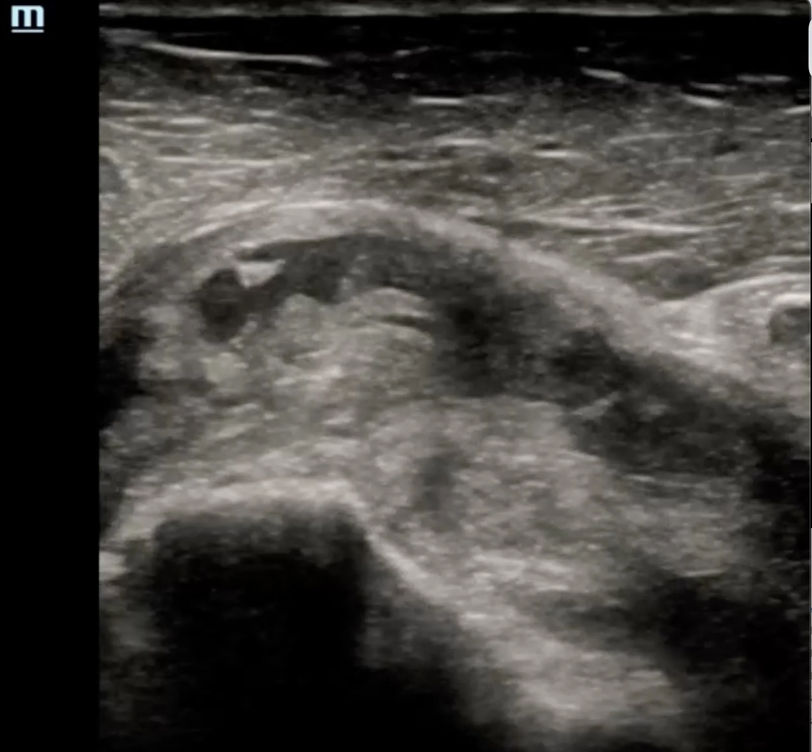 Intern Ultrasound of the Month: Rotator Cuff Injury