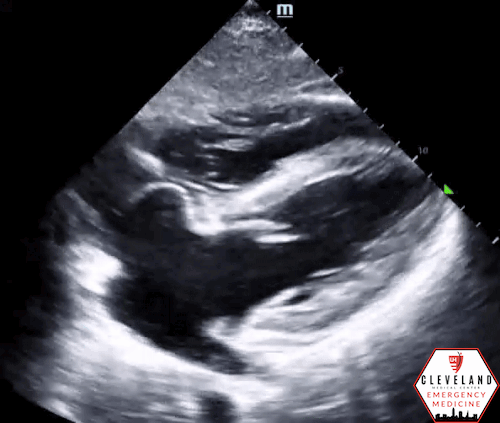 Intern Ultrasound of the Month: A Left Atrial Aneurysm & Review of the  Basics — University Hospitals Emergency Medicine Residency