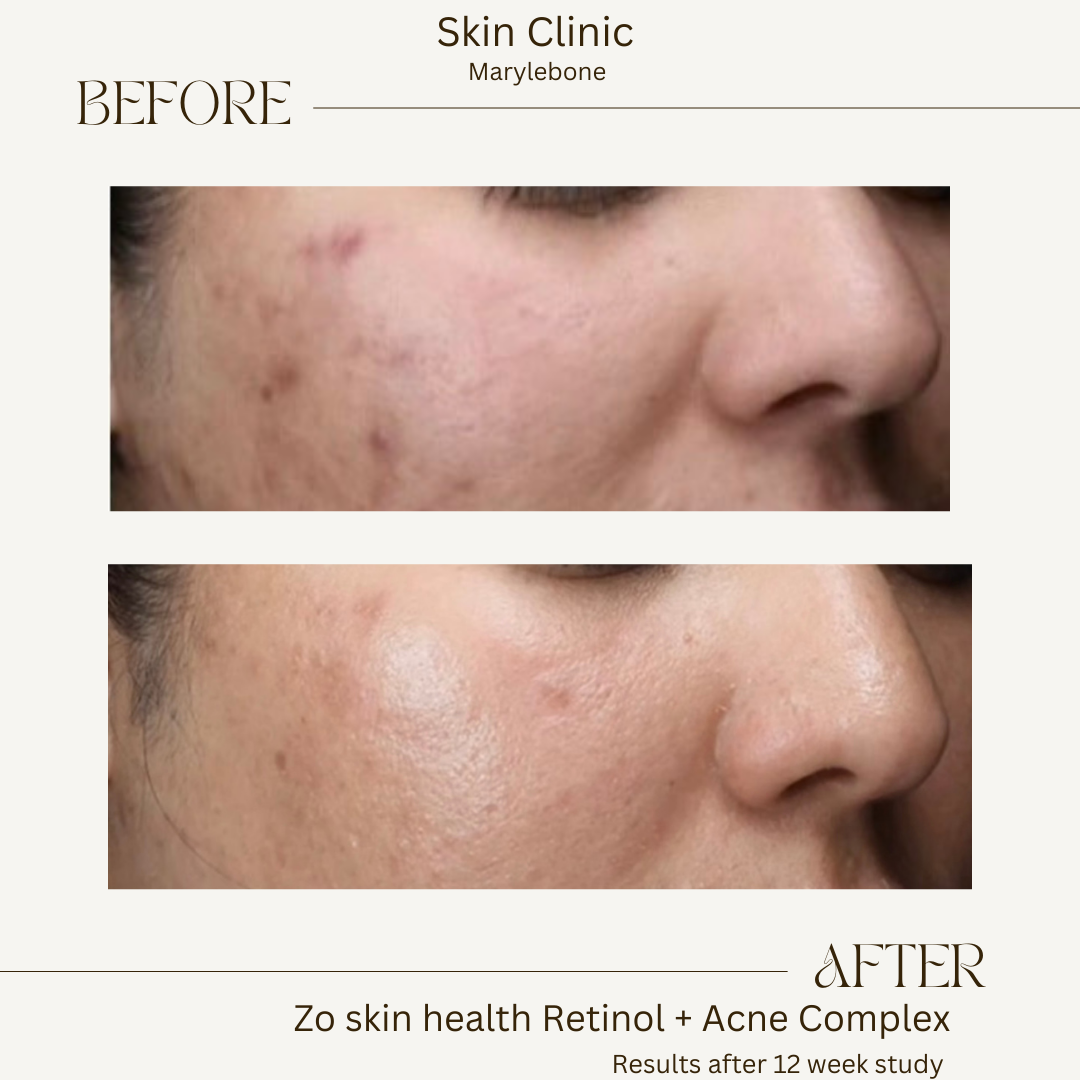 before and after retinol.PNG