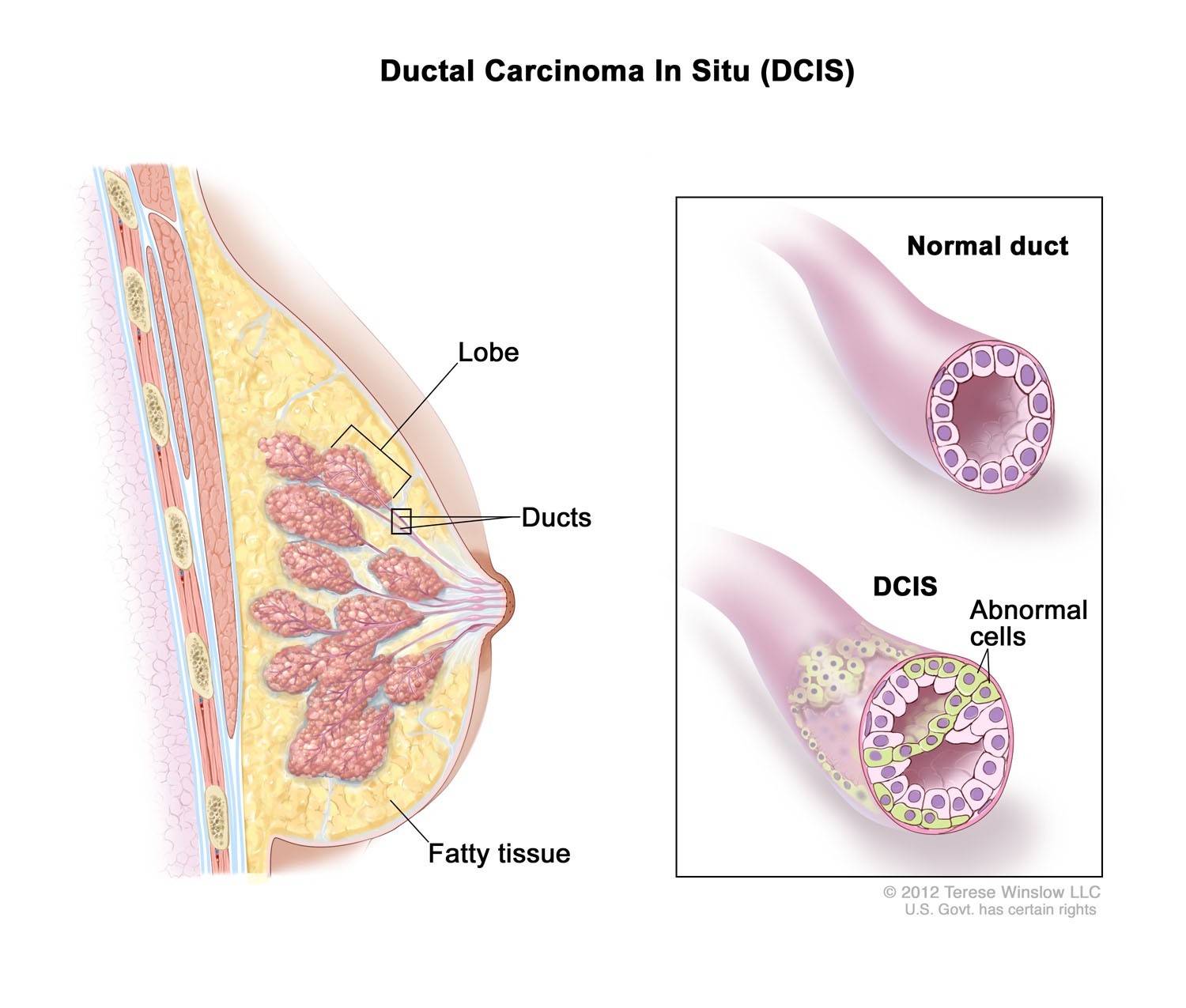 Ductal Carcinoma In Situ (DCIS)