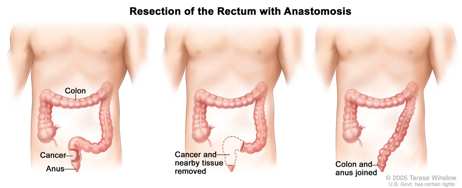 Resection of the Rectum with Anastomosis