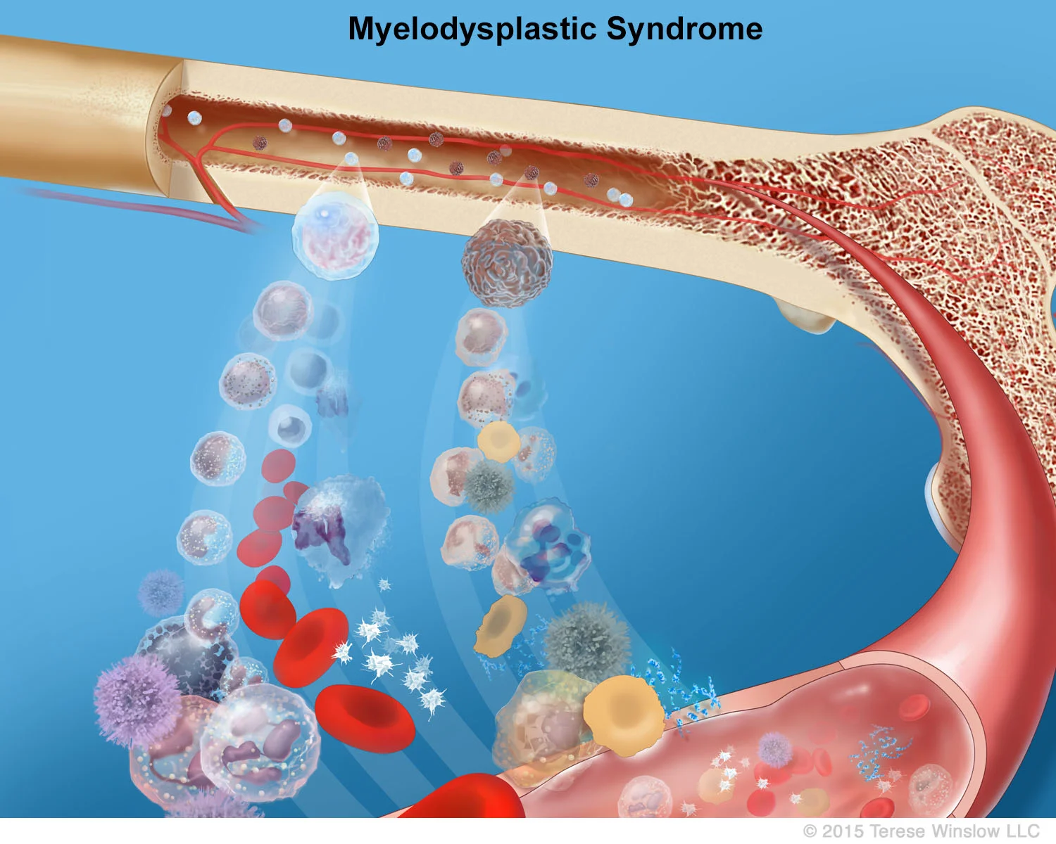 Myelodysplastic Syndrome