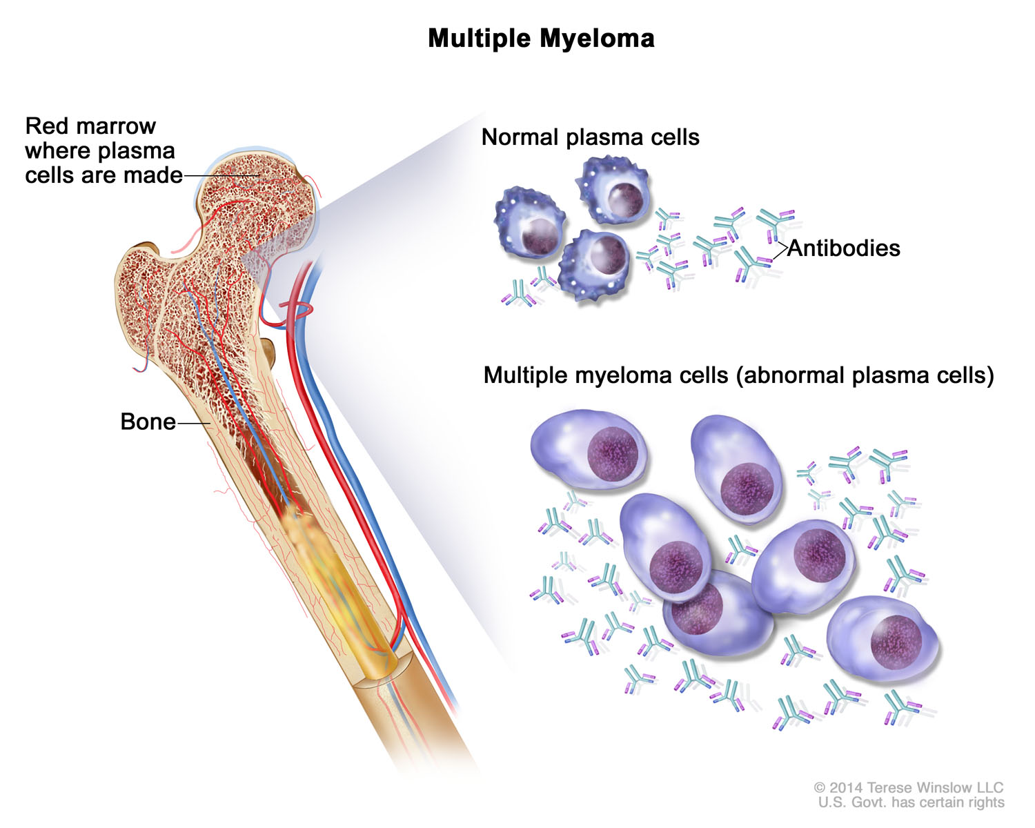 Multiple Myeloma