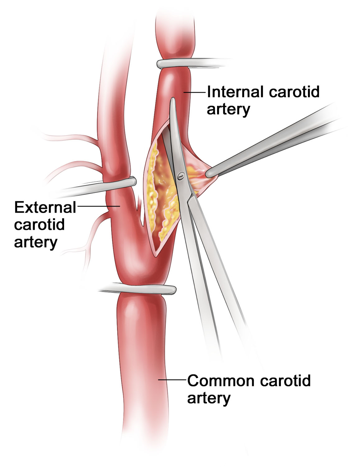 Carotid Endarterectomy (detail)