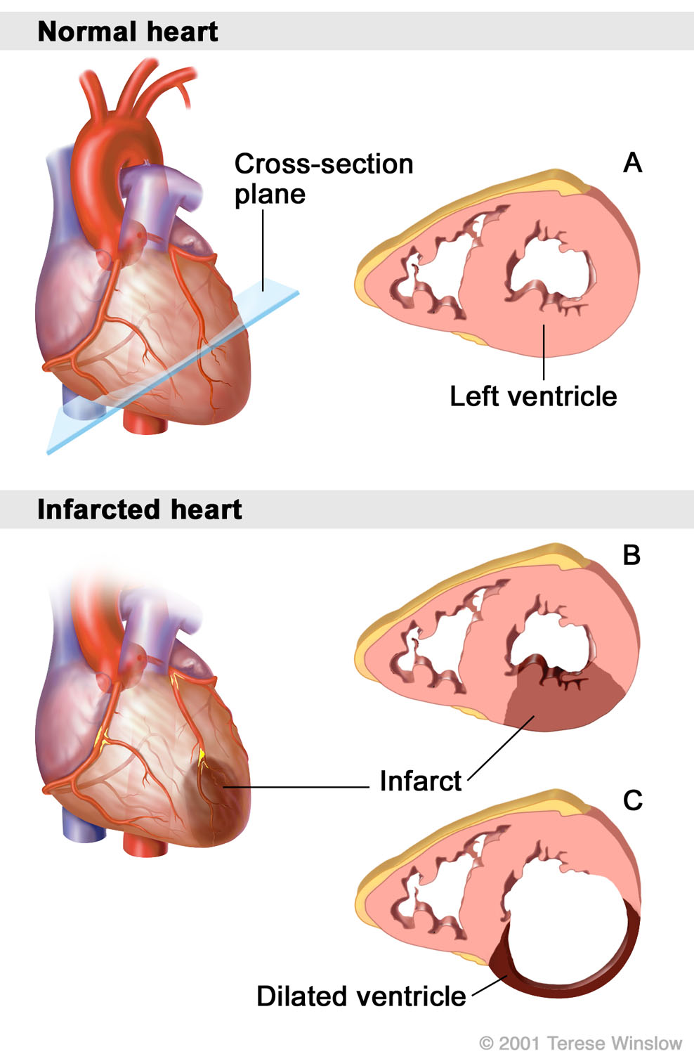 Normal Heart vs. Infarcted Heart