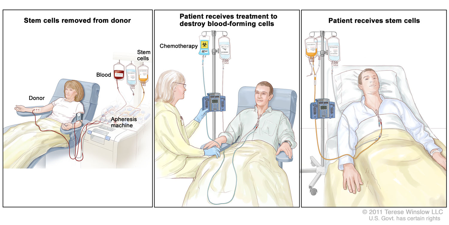 Stem Cell Transplant (Panels 1, 2, and 3)