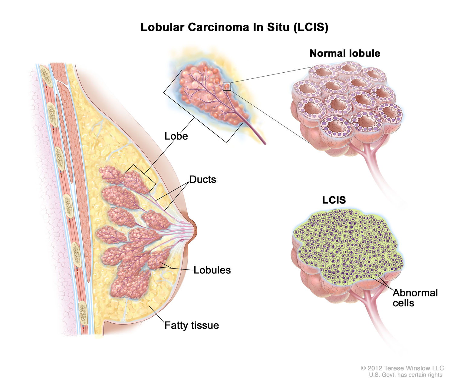 Lobular Carcinoma In Situ (LCIS)