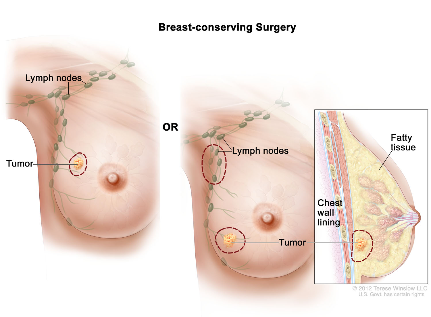 Breast-conserving Surgery