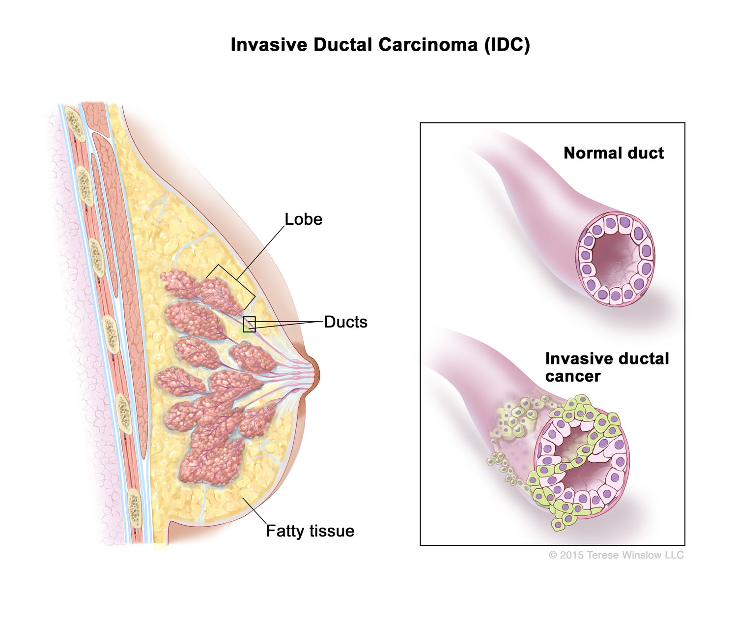 Invasive Ductal Carcinoma (IDC)