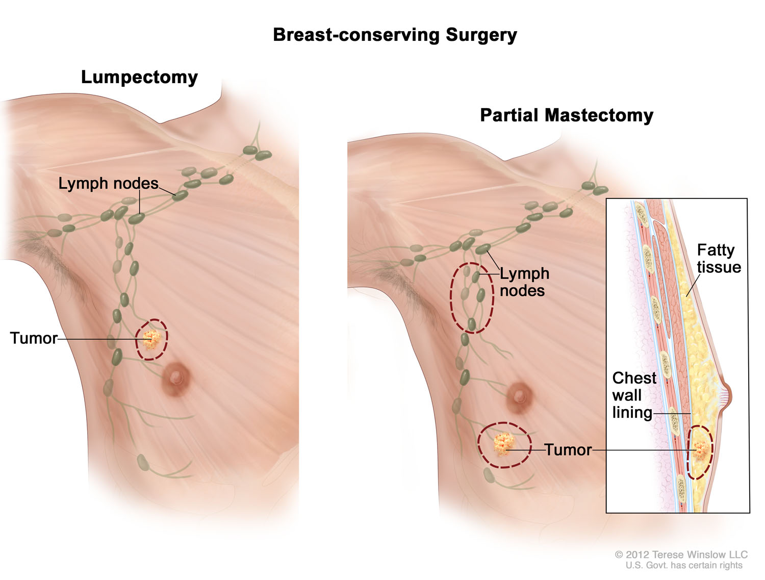 Breast-conserving Surgery Male