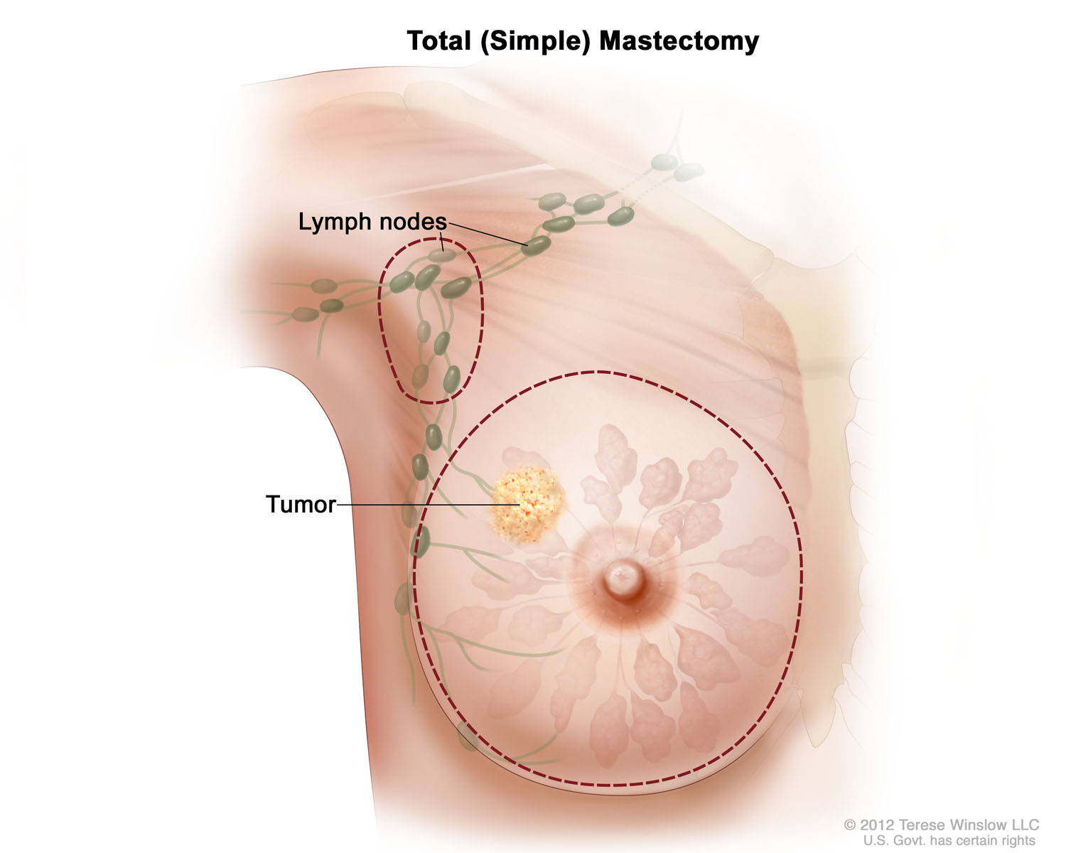 Total (Simple) Mastectomy