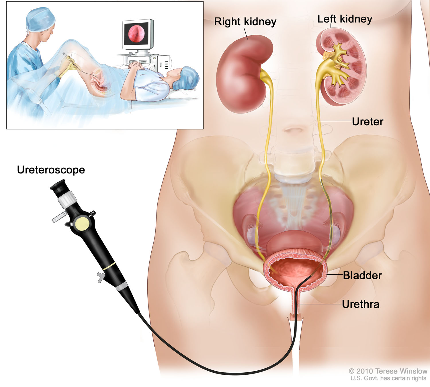 Ureteroscopy