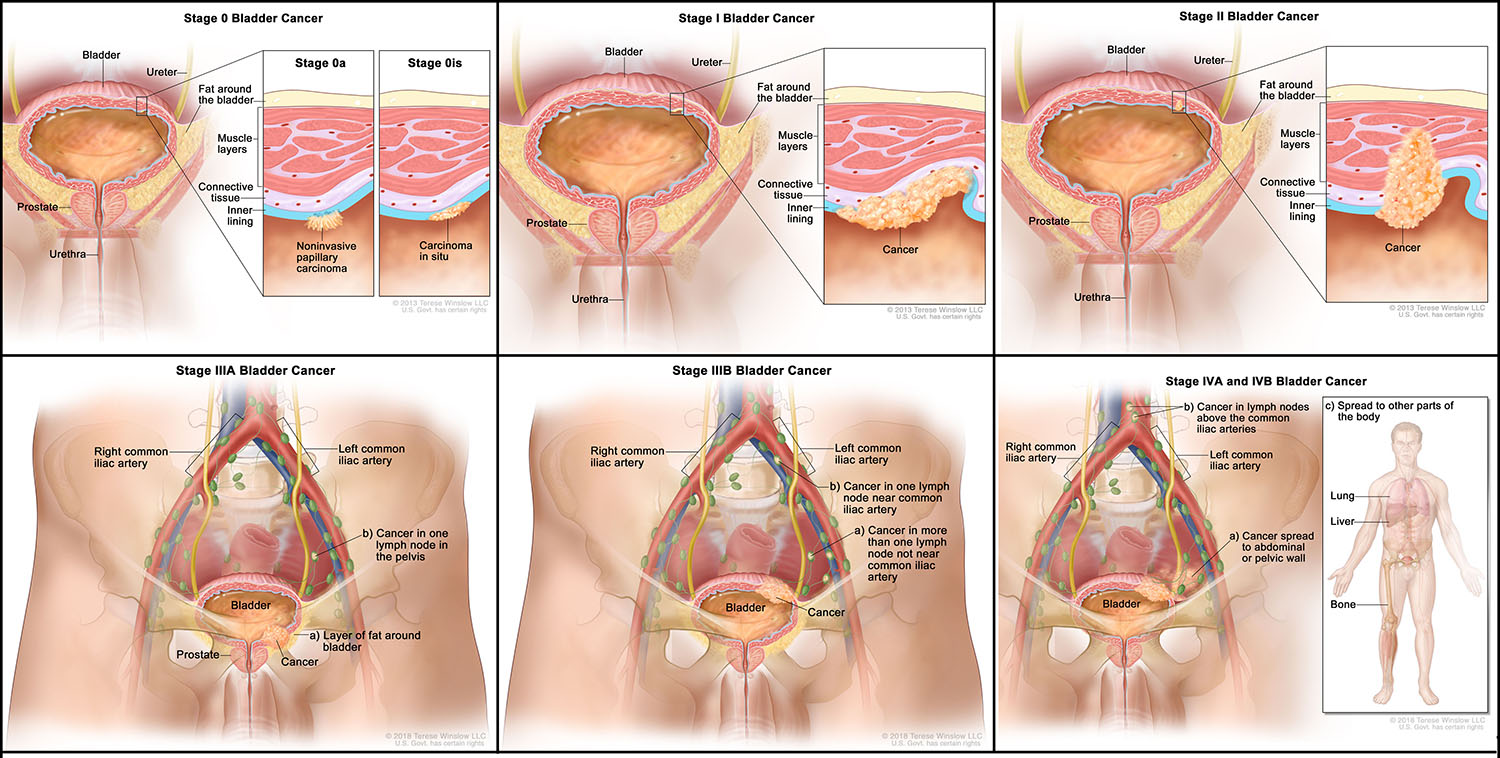 Bladder Cancer Stages (AJCC 8th edition)