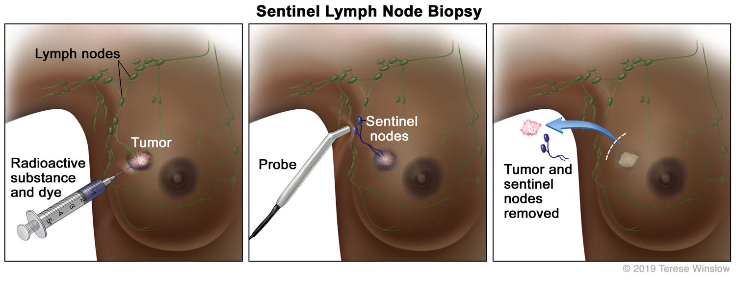 Biopsy, Sentinel Lymph Node, Breast (3-Panel) FP VI 2019 