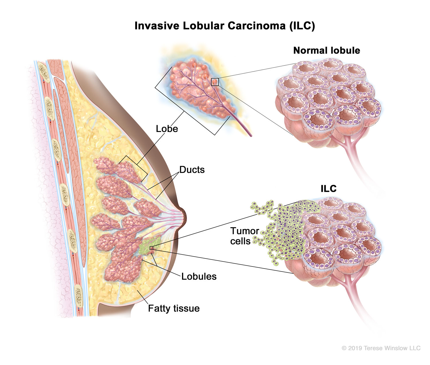 Invasive Lobular Carcinoma (ILC) (Brown Skin)