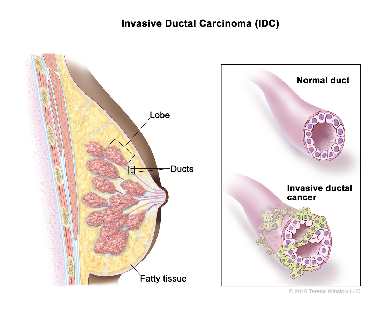 Invasive Ductal Carcinoma (IDC) (Brown Skin)