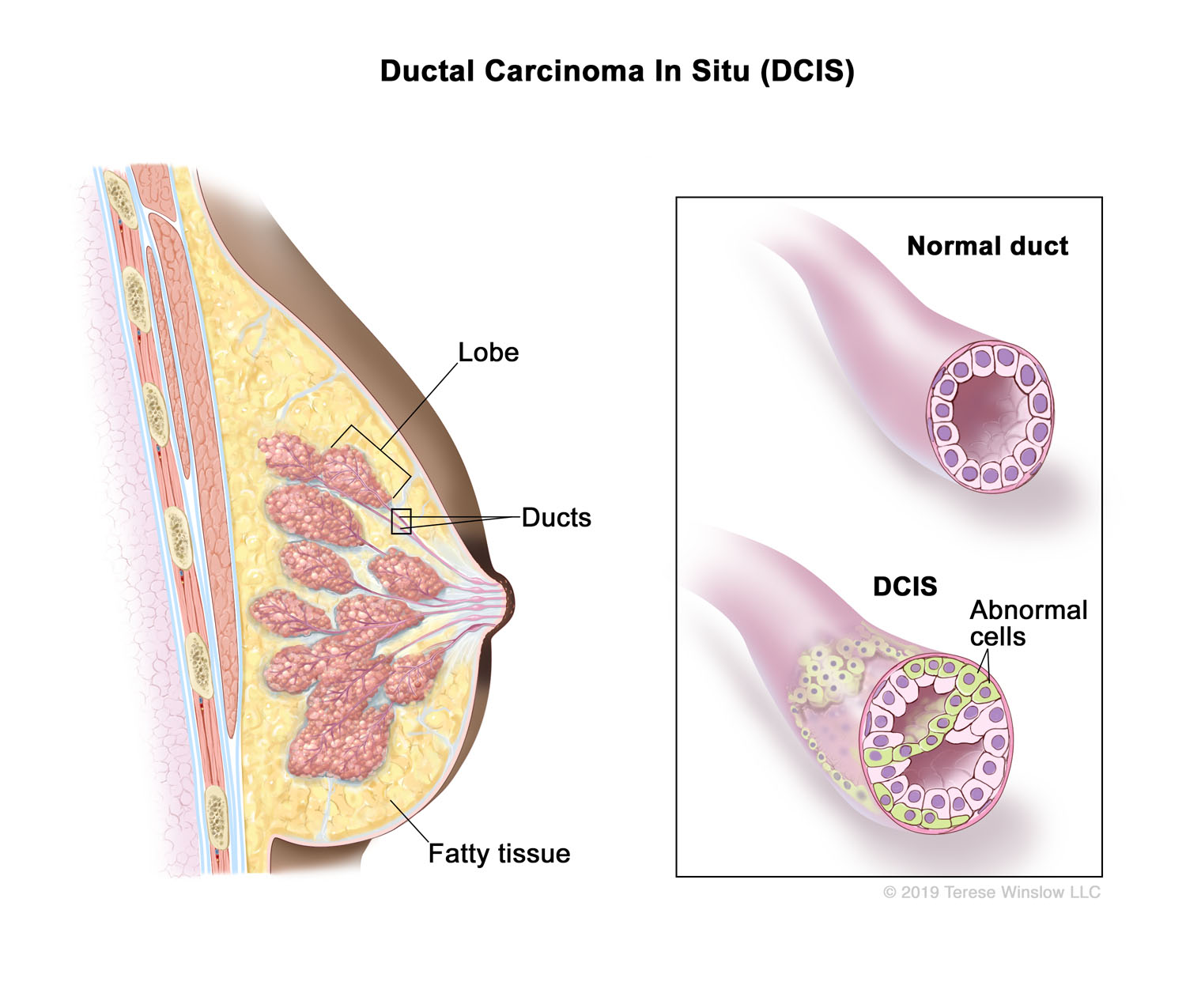 Ductal Carcinoma In Situ (DCIS) (Brown Skin)