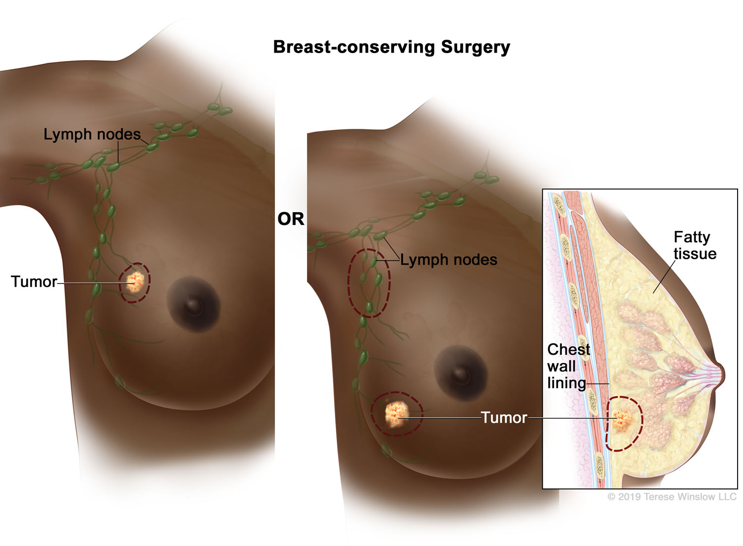 Breast-conserving Surgery (Brown Skin)