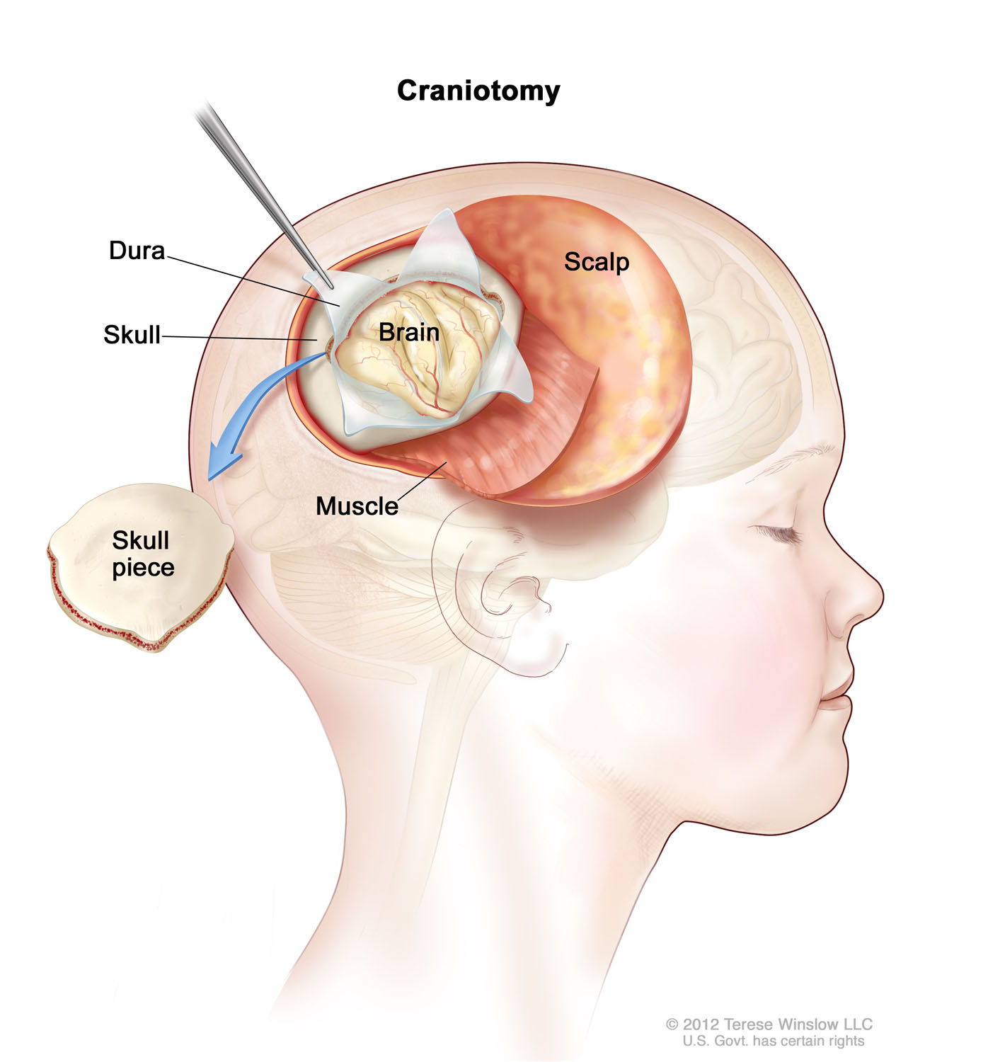 Craniotomy Child 