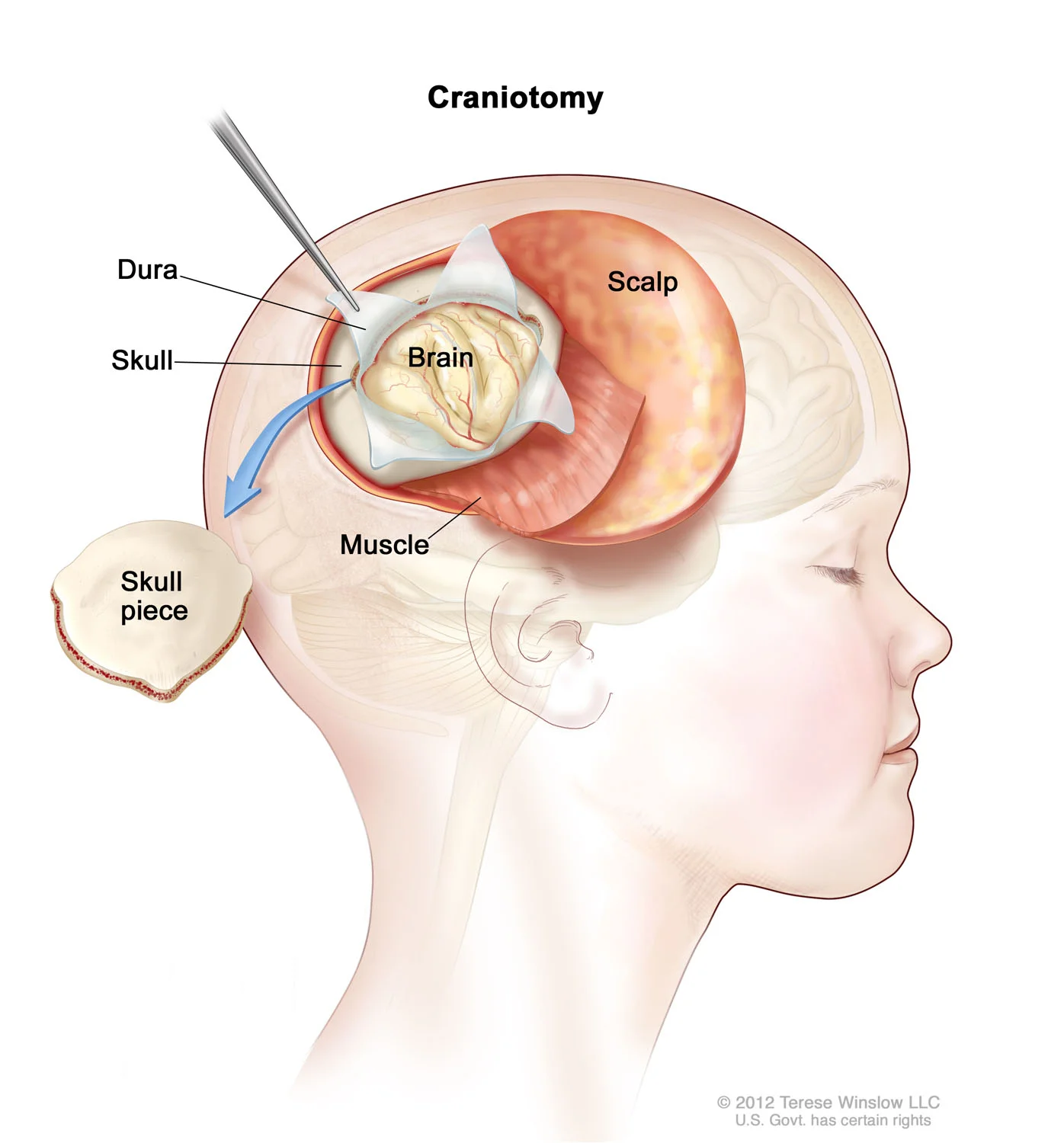 brain-craniotomy-child.jpg