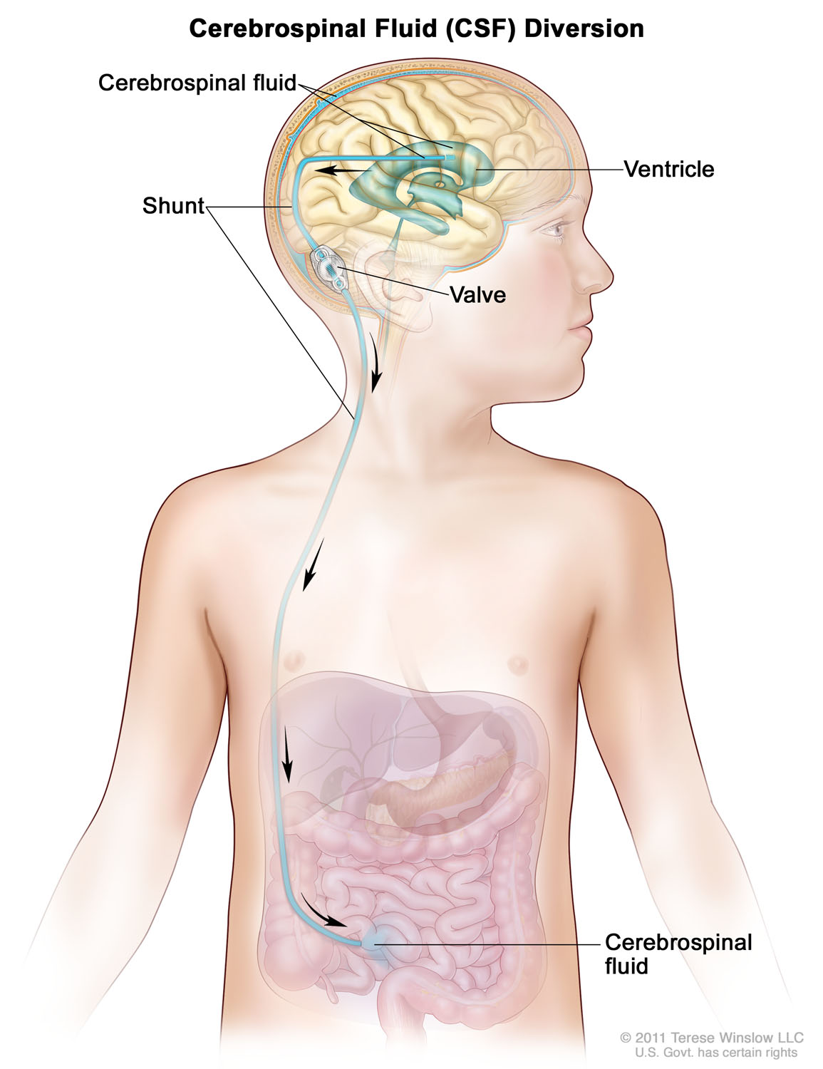 Cerebrospinal Fluid (CSF) Diversion 