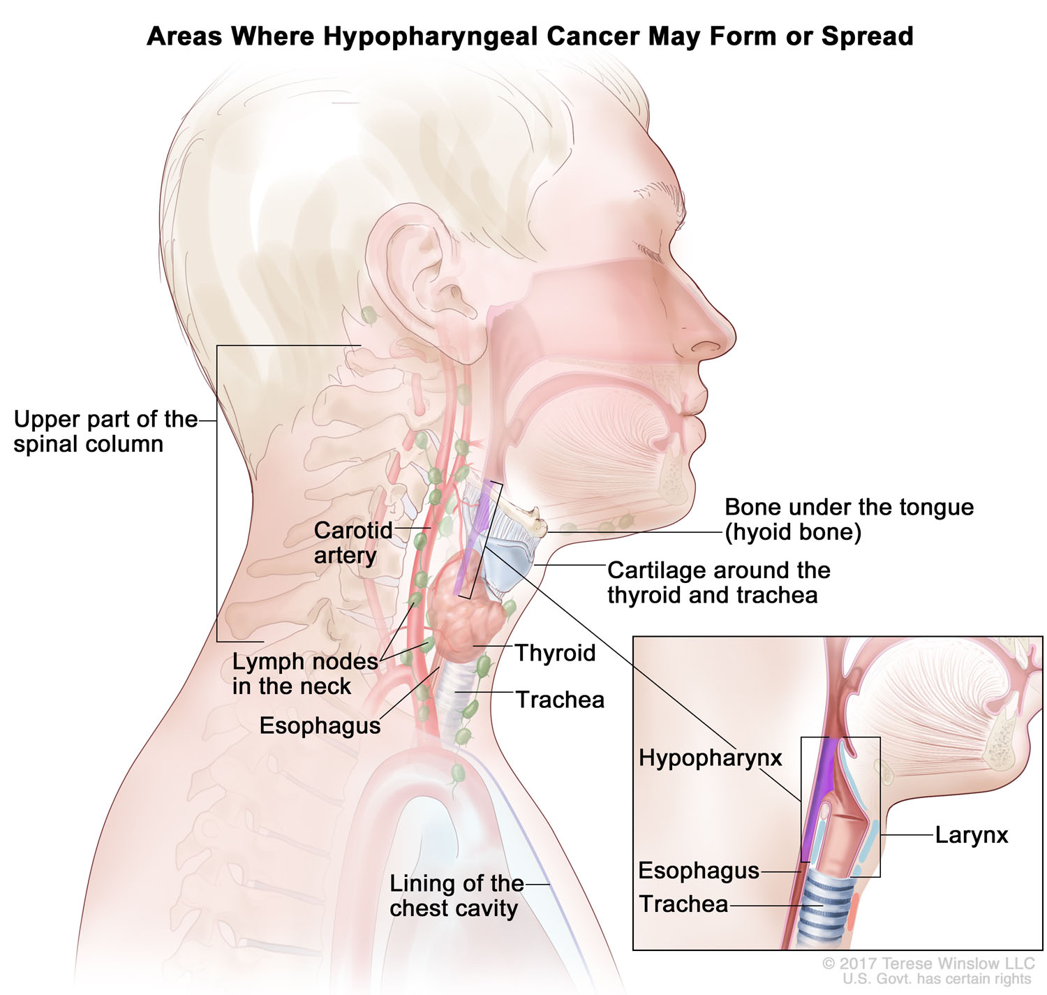 Hypopharyngeal Cancer