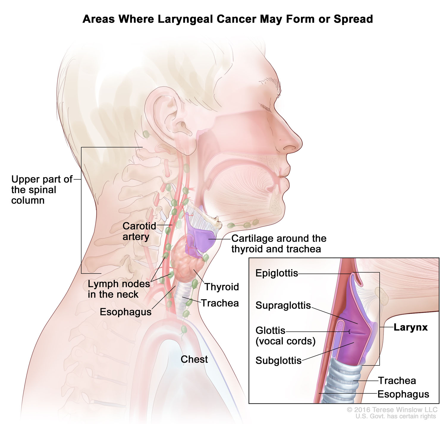 Laryngeal Cancer 