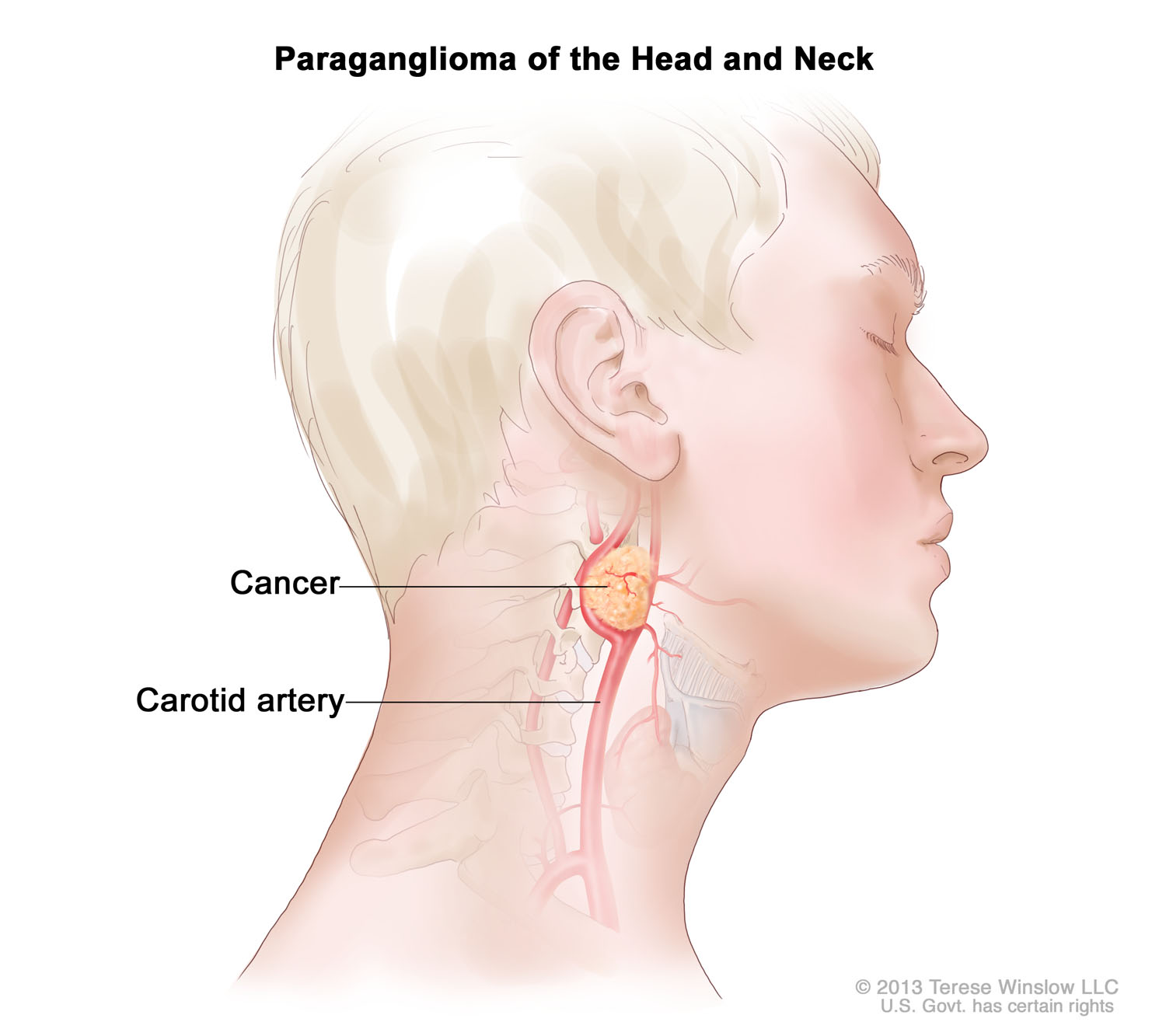 Paraganglioma of the Head and Neck