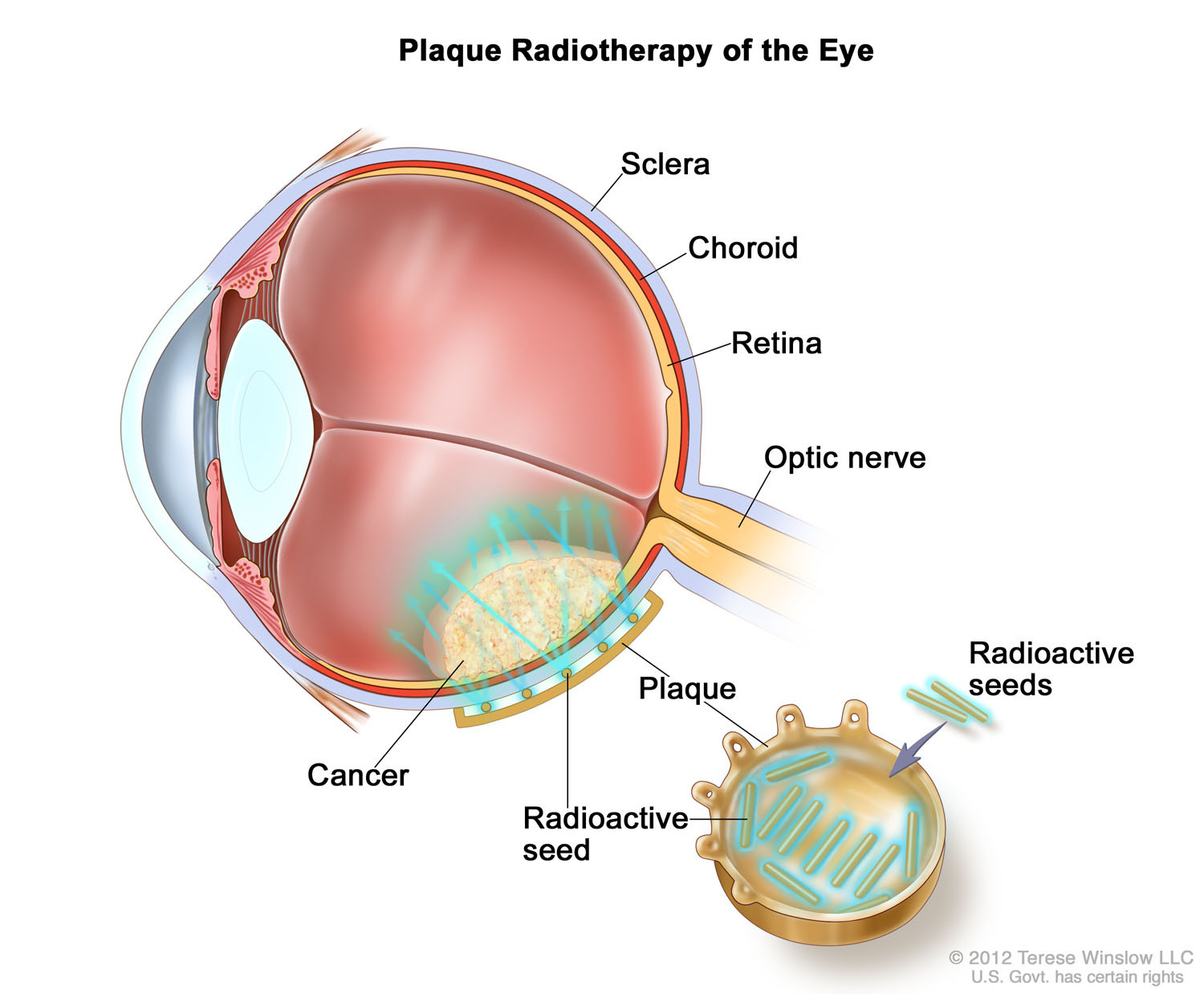  Plaque Radiotherapy of the Eye