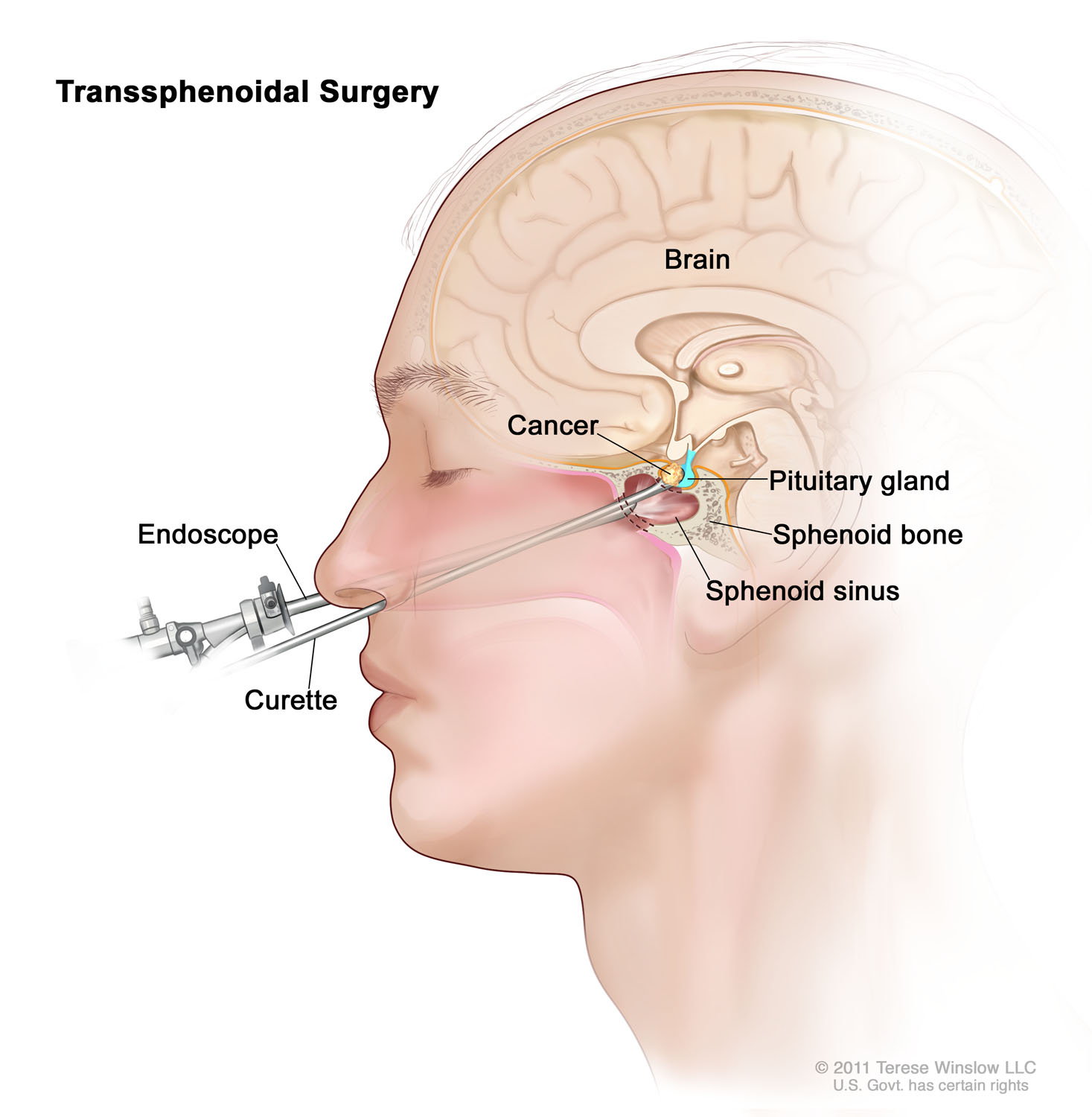 Transsphenoidal Surgery 2011 