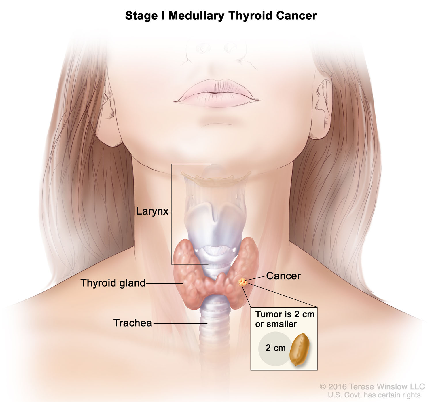 Medullary Thyroid Cancer Stage 1