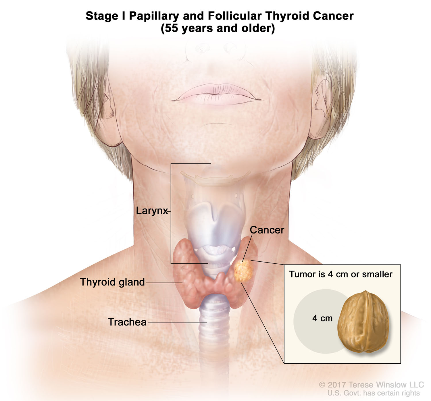 Thyroid Cancer, Papillary and Follicular, Stage I (55 Years and Older) 2017 