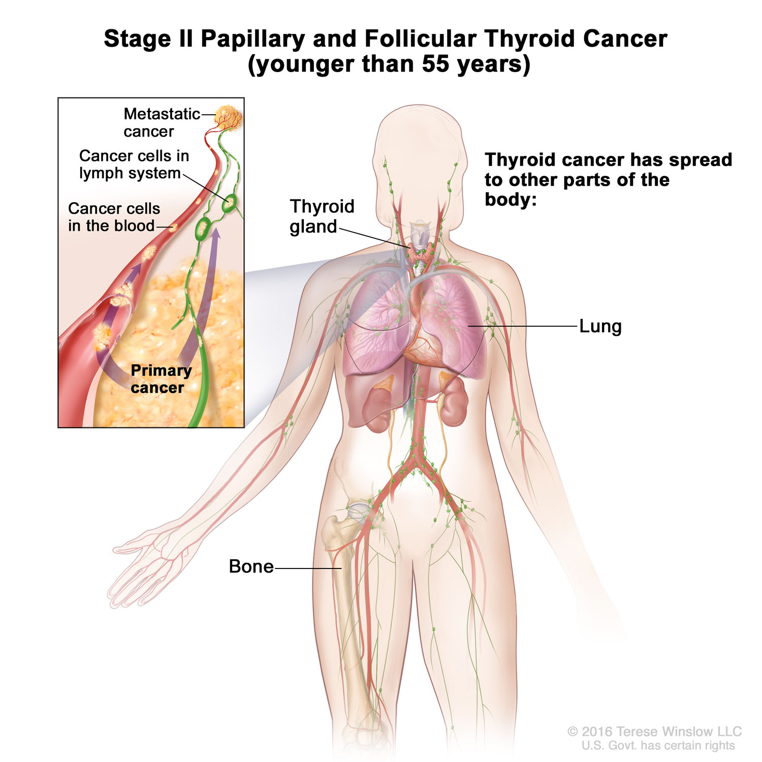 Thyroid Cancer, Papillary and Follicular, Stage II (Younger Than 55 Years) 2016 