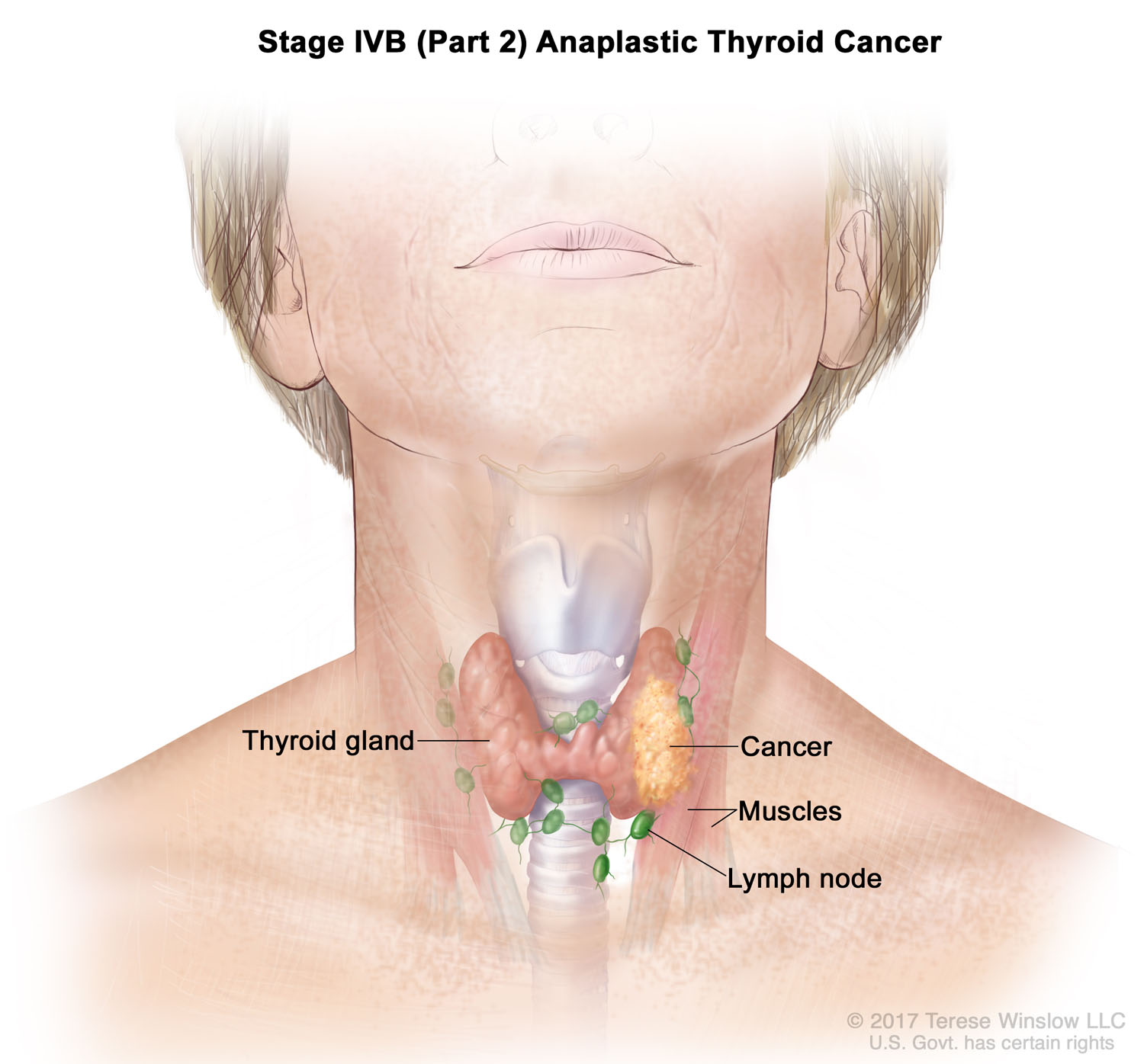 thyroid-cancer-anaplastic-stage4bpart2.jpg