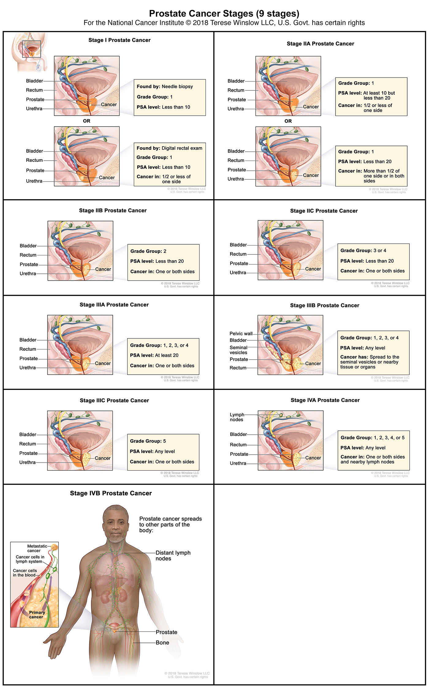 Prostate Cancer Stages (AJCC 8th edition)