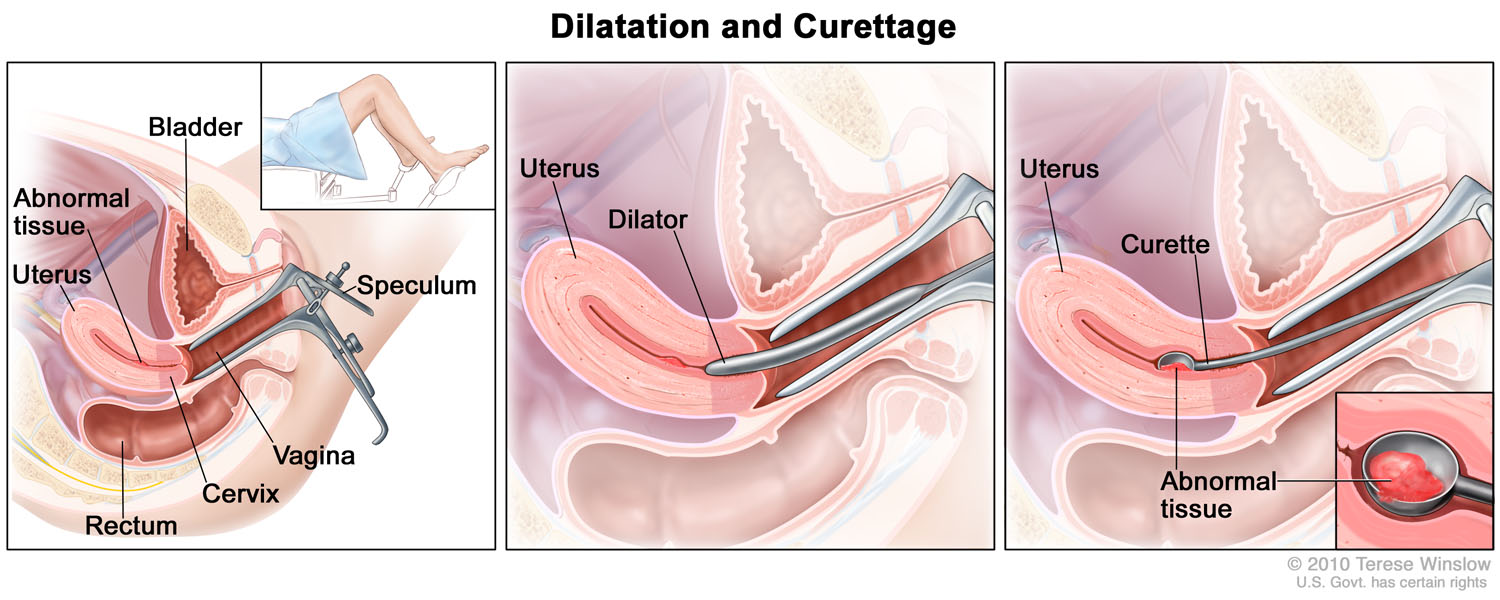 dilatation-and-curettage.jpg