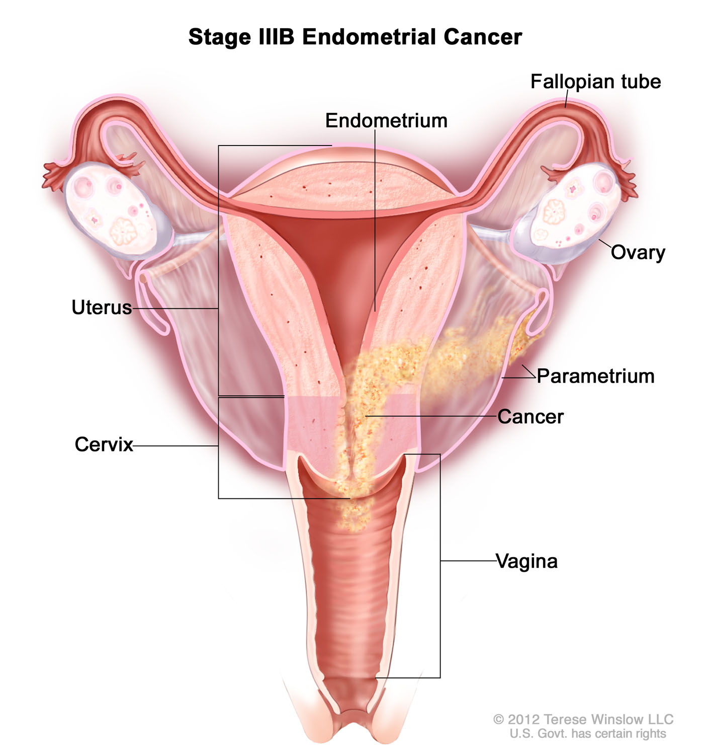 endometrial-cancer-stage3b.jpg